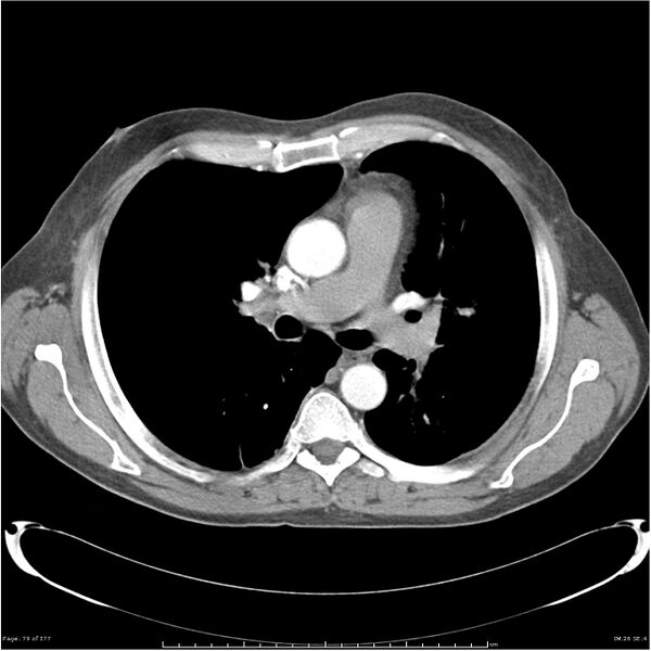 File:Atypical pneumonia - Q fever (Radiopaedia 21993-21989 C+ arterial phase 21).jpg
