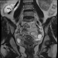 Atypical retroperitoneal lymphocoeles with large leiomyoma of uterus (Radiopaedia 32084-33027 Coronal T2 23).jpg