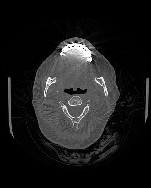 File:Automastoidectomy with labyrinthine fistula (Radiopaedia 84143-99411 Axial non-contrast 7).jpg