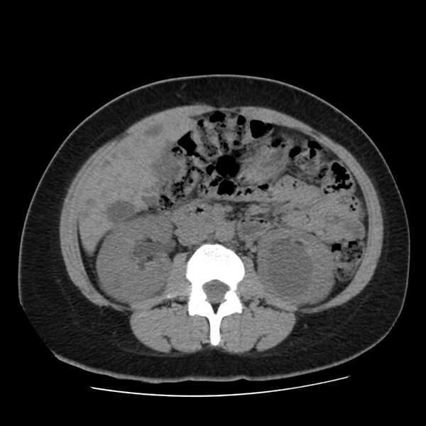 File:Autosomal dominant polycystic kidney disease (Radiopaedia 23061-23093 Axial non-contrast 30).jpg