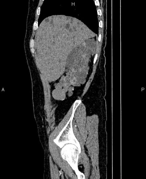 File:Autosomal dominant polycystic kidney disease (Radiopaedia 87830-104287 C 13).jpg