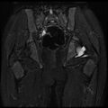 Avascular necrosis of the hip (Radiopaedia 29563-30067 Coronal T2 fat sat 12).jpg