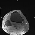Avulsion fracture of the fibular head (Radiopaedia 74804-85808 Axial PD fat sat 34).jpg