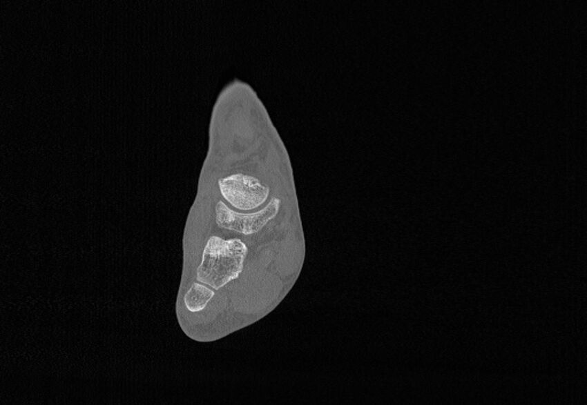 Avulsion fractures of talus and calcaneus (Radiopaedia 48277-53155 Coronal bone window 39).jpg