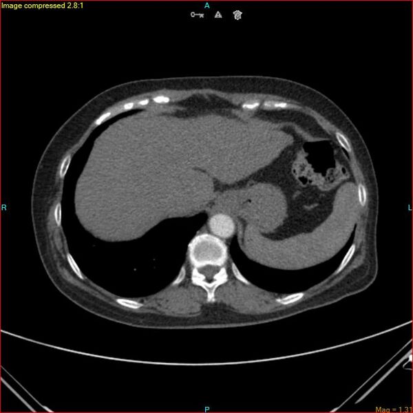File:Azygos vein aneurysm (Radiopaedia 77824-90130 B 46).jpg