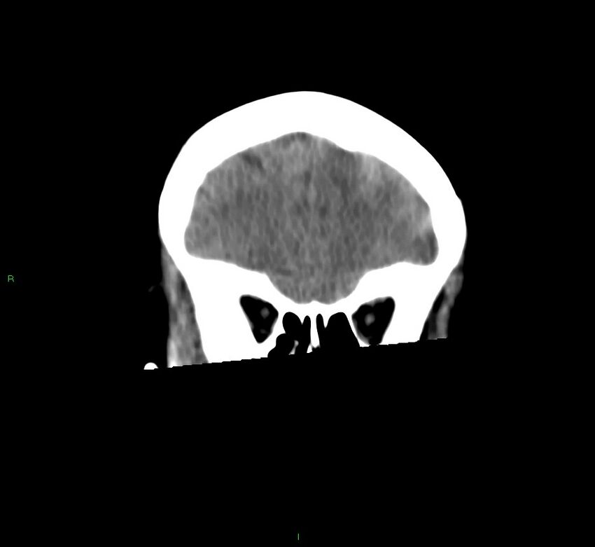Basal ganglia hemorrhage (Radiopaedia 58759-65981 Coronal non-contrast 53).jpg