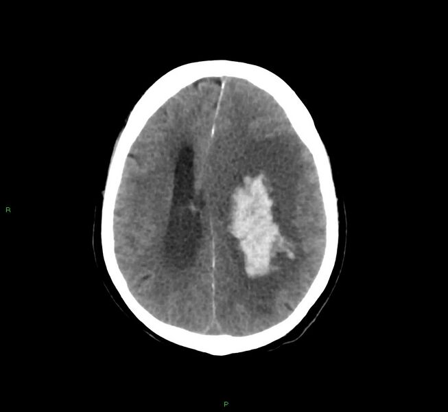 File:Basal ganglia hemorrhage (Radiopaedia 58775-66008 Axial non-contrast 24).jpg