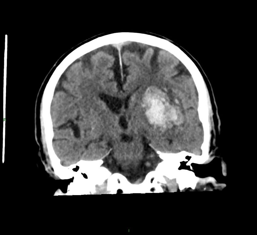 Basal ganglia hemorrhage (Radiopaedia 58791-66025 Coronal non-contrast 32).jpg