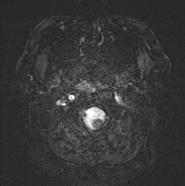 File:Basilar artery dissection (Radiopaedia 77032-88976 Axial SWI 2).jpg