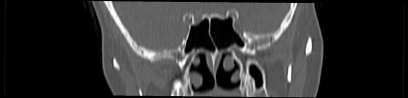 File:Basilar impression (Radiopaedia 52411-58522 Coronal bone window 5).jpg