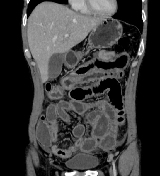 File:Behçet's disease- abdominal vasculitis (Radiopaedia 55955-62570 B 13).jpg