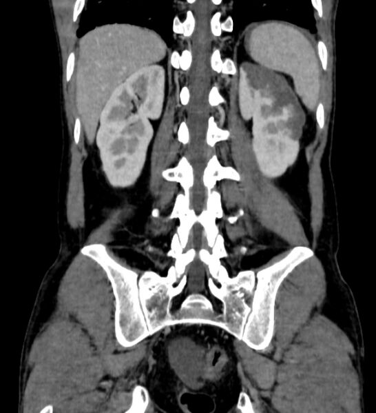 File:Behçet's disease- abdominal vasculitis (Radiopaedia 55955-62570 B 47).jpg