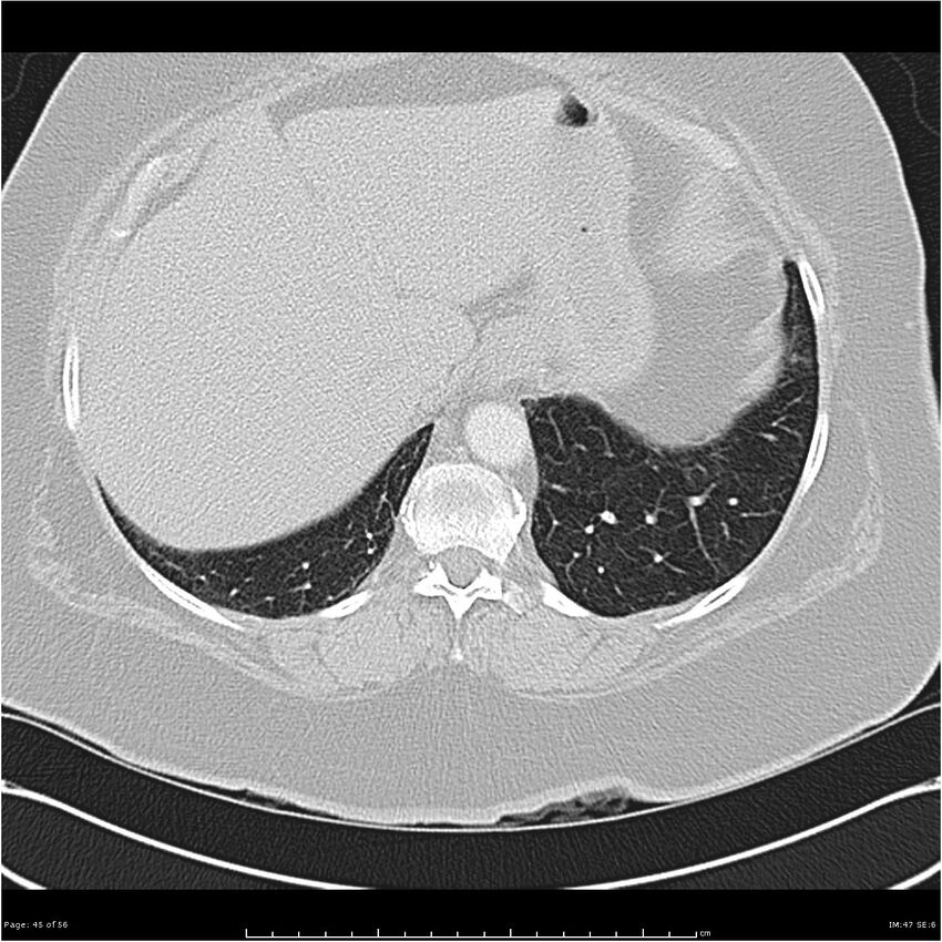 Benign metastasizing leiomyoma (Radiopaedia 26803-26962 Axial lung window 45).jpg