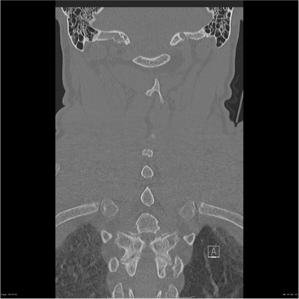 File:Bilateral cervical ribs (Radiopaedia 25868-26017 Coronal bone window 39).jpg