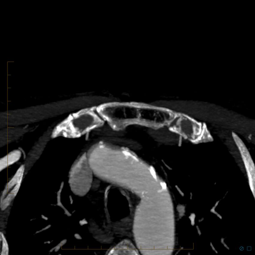 Bilateral chronic common carotid occlusion (Radiopaedia 50849-56362 D 60).jpg