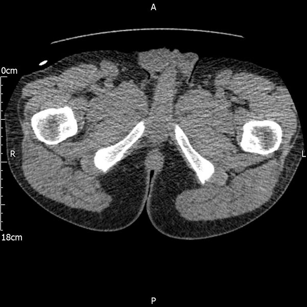 File:Bilateral medullary nephrocalcinosis with ureteric calculi (Radiopaedia 71269-81569 Axial non-contrast 147).jpg
