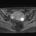 Bilateral ovarian endometriomas (Radiopaedia 87085-103347 Axial T1 fat sat 11).jpg