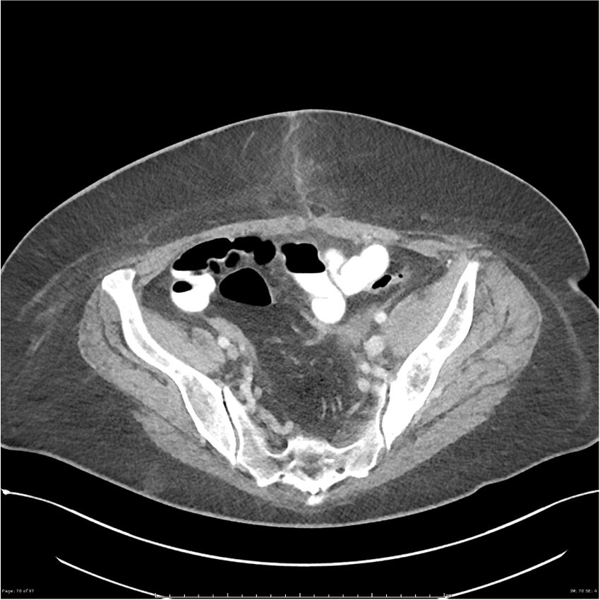 Bilateral psoas hematomas (Radiopaedia 24057-24279 A 70).jpg