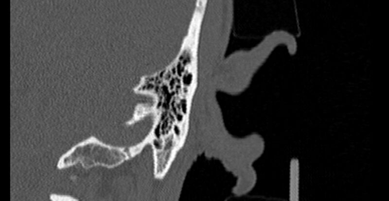 File:Bilateral temporal bone fractures (Radiopaedia 29482-29970 B 93).jpg