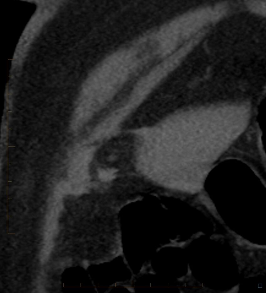 Bile leak from accessory duct(s) of Luschka post cholecystectomy (Radiopaedia 40736-43389 B 4).jpg
