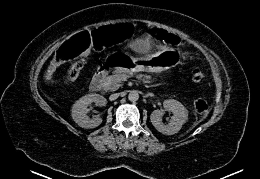 Biliary pancreatitis (Radiopaedia 72289-82823 Axial non-contrast 115).jpg