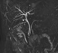 Biliary tree anatomical variant - biliary trifurcation (Radiopaedia 12531-12750 Coronal MRCP 1).jpg