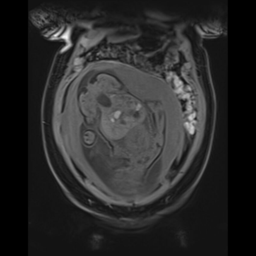Bilobed placenta accreta (Radiopaedia 69648-79591 Coronal T1 vibe 45).jpg