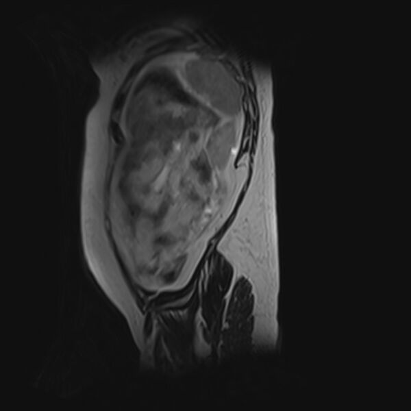 File:Bilobed placenta accreta (Radiopaedia 69648-79591 G 5).jpg