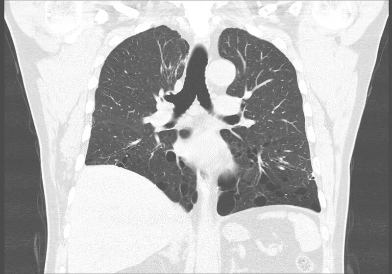 File:Birt-Hogg-Dubé syndrome (Radiopaedia 52578-58491 Coronal lung window 32).jpg