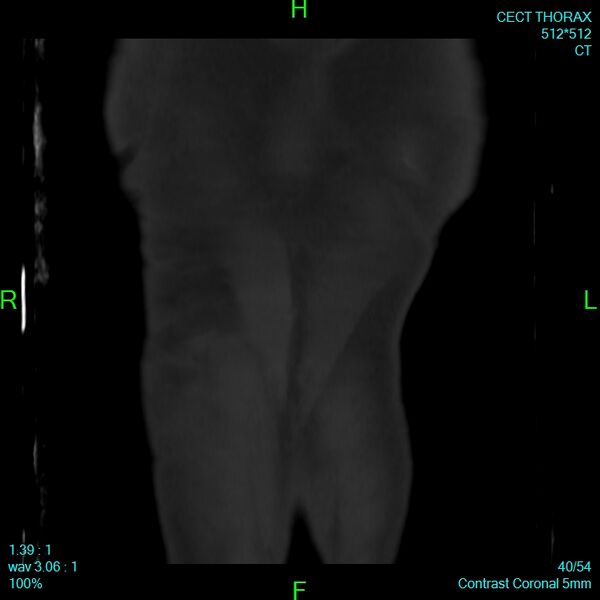 File:Bone metastases from lung carcinoma (Radiopaedia 54703-60937 Coronal bone window 40).jpg