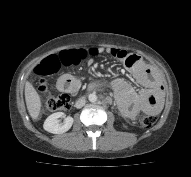 File:Bowel lymphoma complicated by bleeding after therapy (Radiopaedia 55601-62107 A 39).jpg
