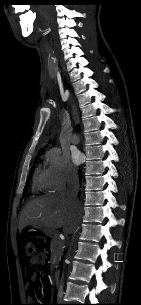 File:Brachiocephalic trunk pseudoaneurysm (Radiopaedia 70978-81191 C 45).jpg