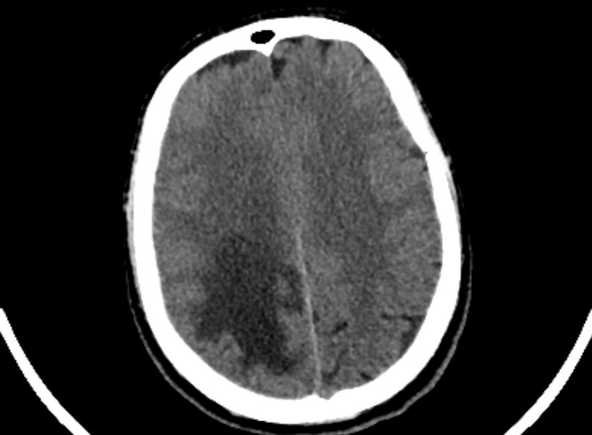 Brain abscess complicated by intraventricular rupture and ventriculitis (Radiopaedia 82434-96575 Axial non-contrast 83).jpg