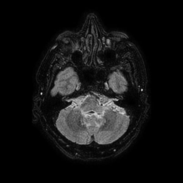 File:Brain abscess complicated by intraventricular rupture and ventriculitis (Radiopaedia 82434-96577 Axial FLAIR 12).jpg