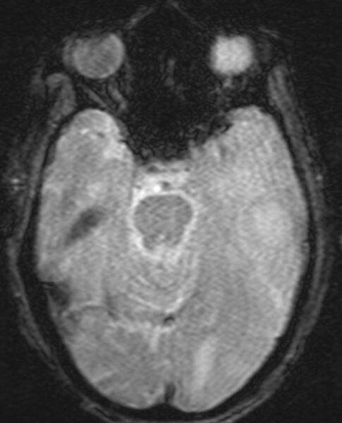 File:Brain abscess with dual rim sign (Radiopaedia 87566-103938 Axial SWI 8).jpg