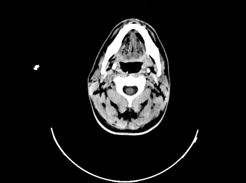 Brain injury by firearm projectile (Radiopaedia 82068-96088 A 41).jpg