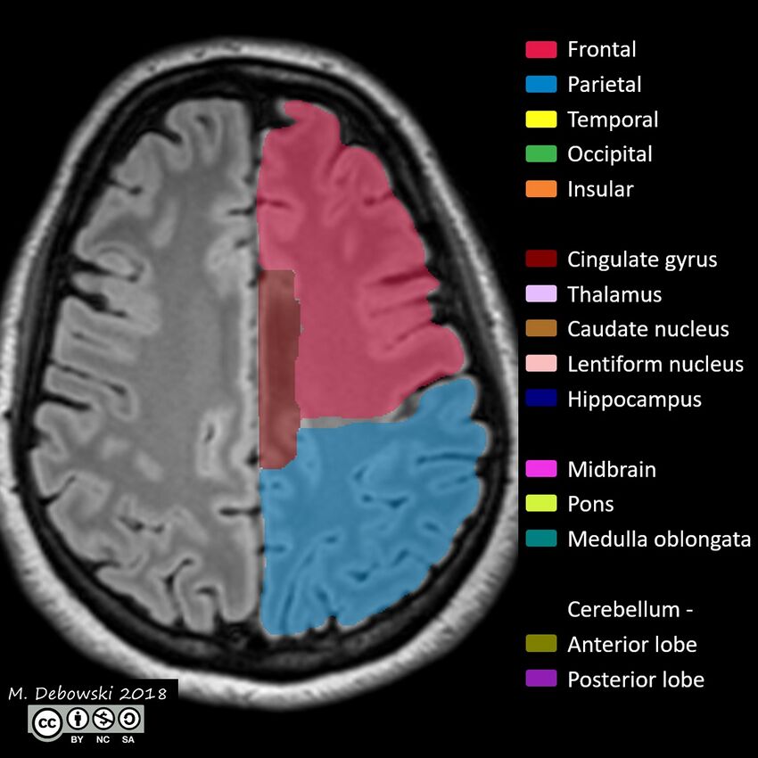 Brain lobes - annotated MRI (Radiopaedia 61691-69700 Axial 22).JPG