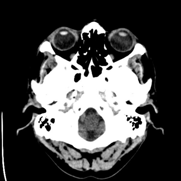 File:Brain metastases from lung cancer (Radiopaedia 24480-24781 Axial non-contrast 3).jpg
