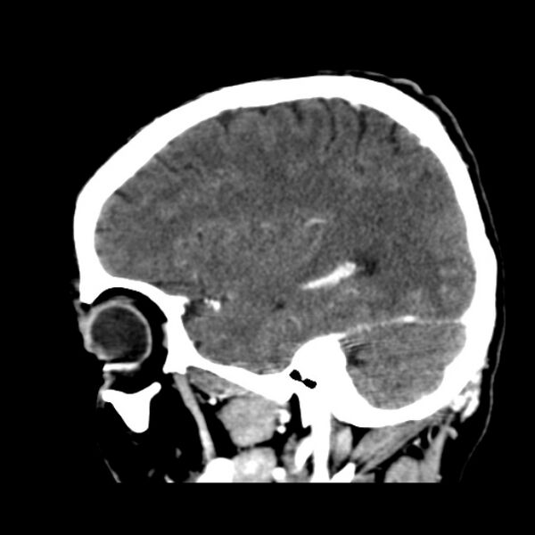 File:Brain metastases from lung cancer (Radiopaedia 24480-24781 C+ delayed 17).jpg