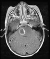 Brainstem glioma (Radiopaedia 11250-11614 D 1).jpg