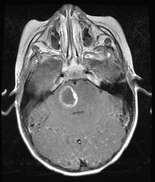 File:Brainstem glioma (Radiopaedia 11250-11614 D 1).jpg