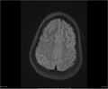Brainstem glioma (Radiopaedia 21819-21775 Axial FLAIR 31).jpg
