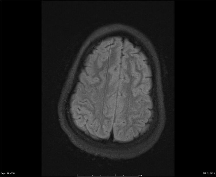 File:Brainstem glioma (Radiopaedia 21819-21775 Axial FLAIR 31).jpg
