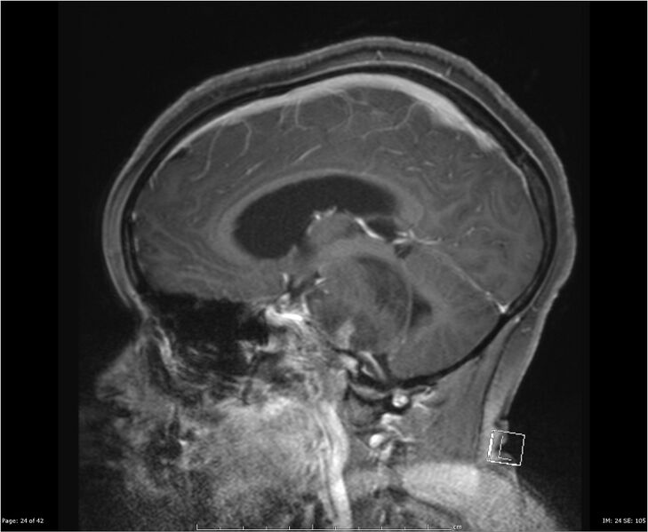 File:Brainstem glioma (Radiopaedia 21819-21775 D 24).jpg