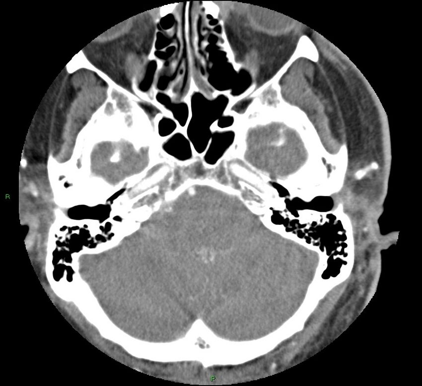 Brainstem hemorrhage (Radiopaedia 58794-66028 D 42).jpg