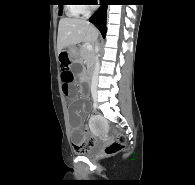 File:Broad ligament hernia (Radiopaedia 63260-71832 C 25).jpg