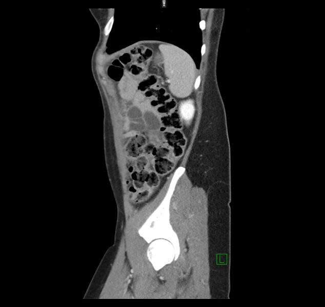 File:Broad ligament hernia (Radiopaedia 63260-71832 C 45).jpg