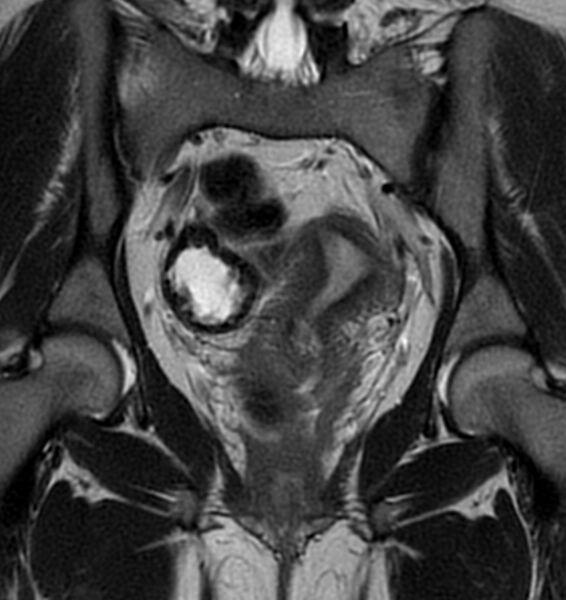File:Broad ligament leiomyoma (Radiopaedia 81634-95516 Coronal T2 14).jpg