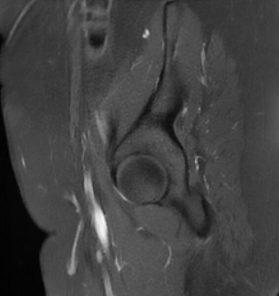 File:Broad ligament leiomyoma (Radiopaedia 81634-95516 G 2).jpg