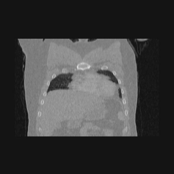 File:Bronchial atresia (Radiopaedia 60685-68439 Coronal lung window 61).jpg